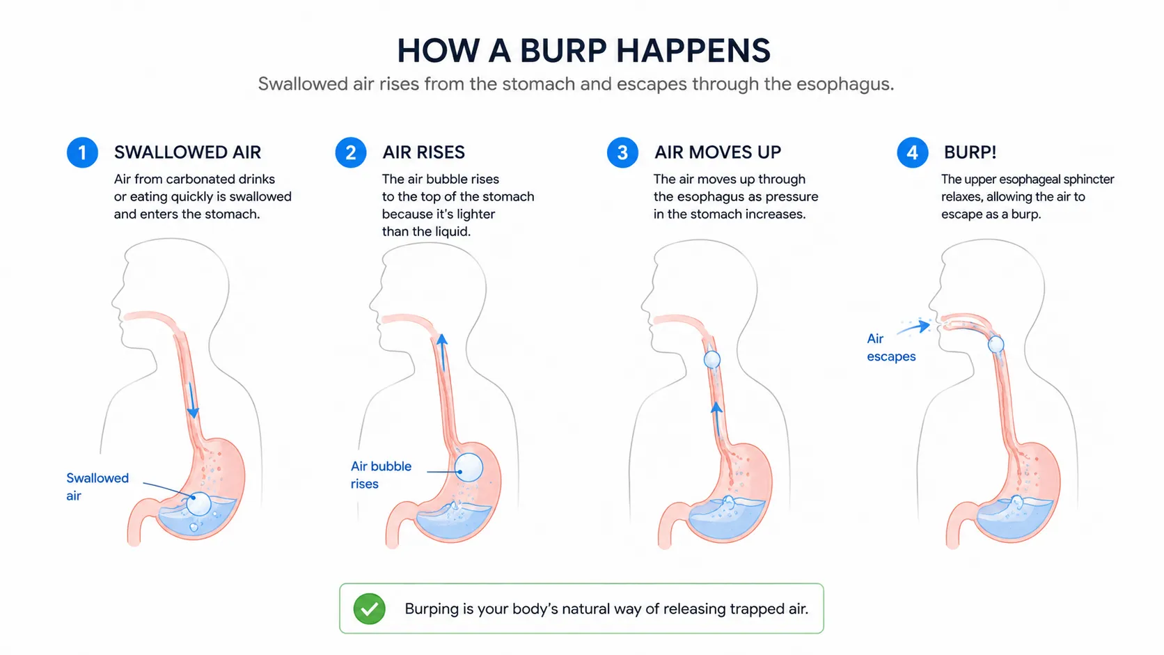 Cross-section diagram of esophagus, lower esophageal sphincter, and stomach showing gas pressure and upward gas flow during burping